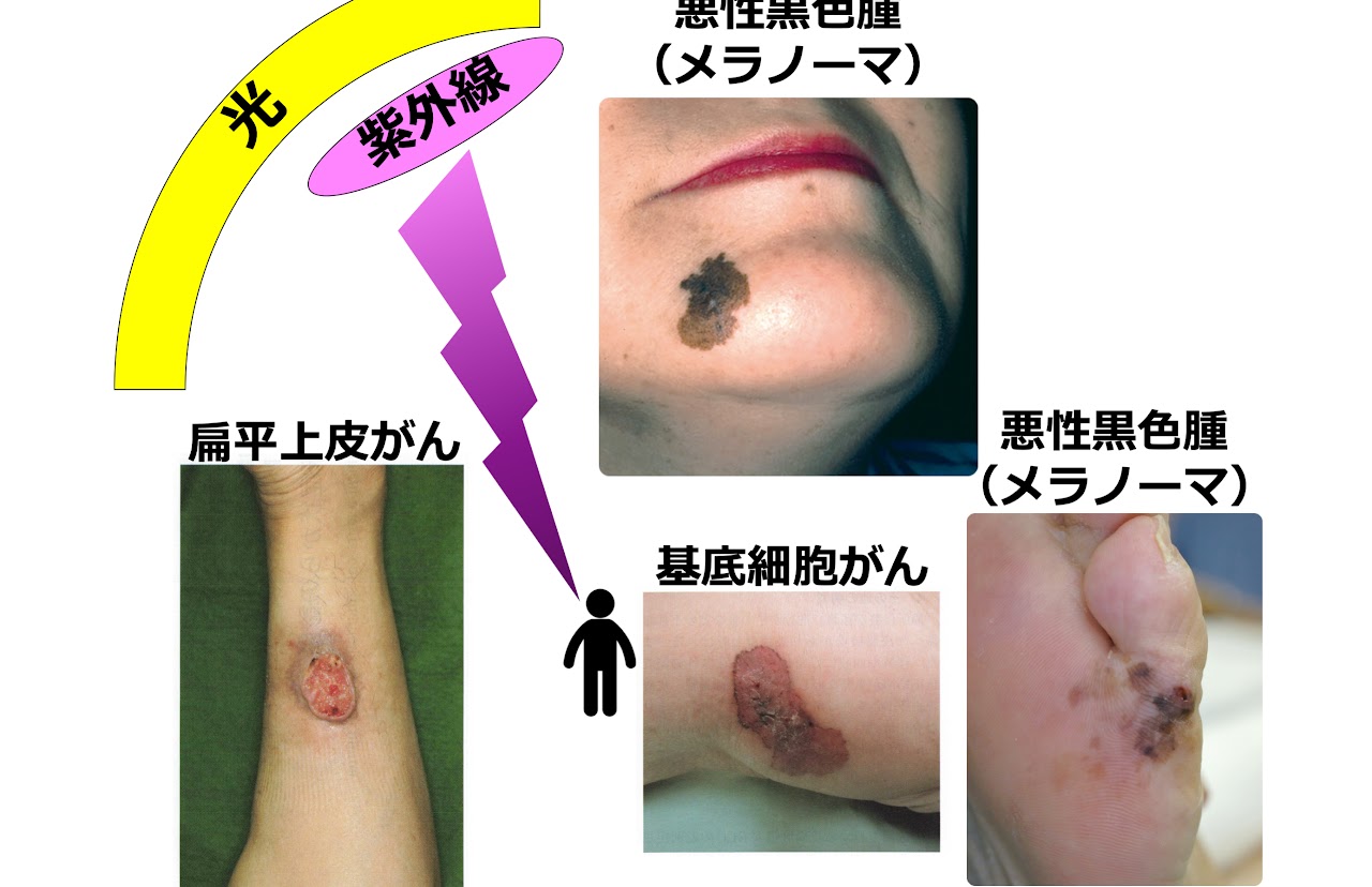 紫外線による皮膚疾患